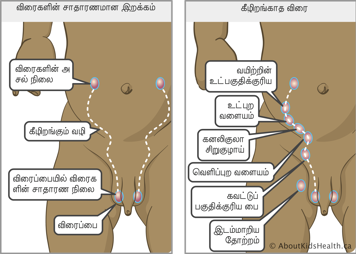 விதைகளின் வழமையான கீழிறக்கப் பாதை மற்றும் கீழிறங்காத விதைகளின் பாதையும் அடிவயிறு மற்றும் விதைப்பைக்கு இடையிலான சாத்தியமான அமைவிடங்களும்