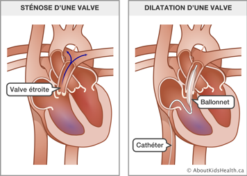 Cœur avec une valve étroite et cœur avec un cathéter et un ballonnet dans un vaisseau sanguin et dans une valve