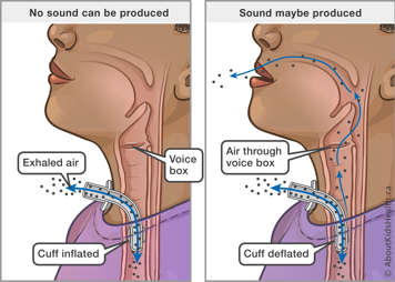 illustration showing exhaled air through the tracheostomy tube with cuff inflated and air passing through the voice box with the cuff deflated to allow vocalization